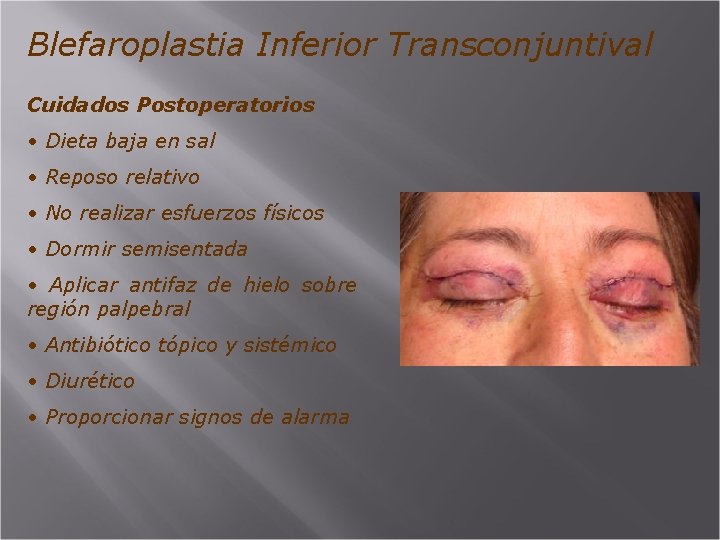 Blefaroplastia Inferior Transconjuntival Cuidados Postoperatorios • Dieta baja en sal • Reposo relativo •