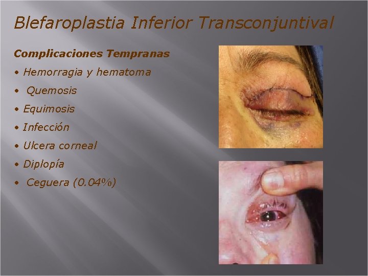 Blefaroplastia Inferior Transconjuntival Complicaciones Tempranas • Hemorragia y hematoma • Quemosis • Equimosis •