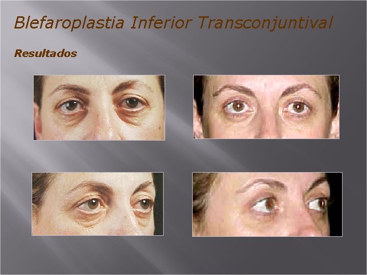 Blefaroplastia Inferior Transconjuntival Resultados 