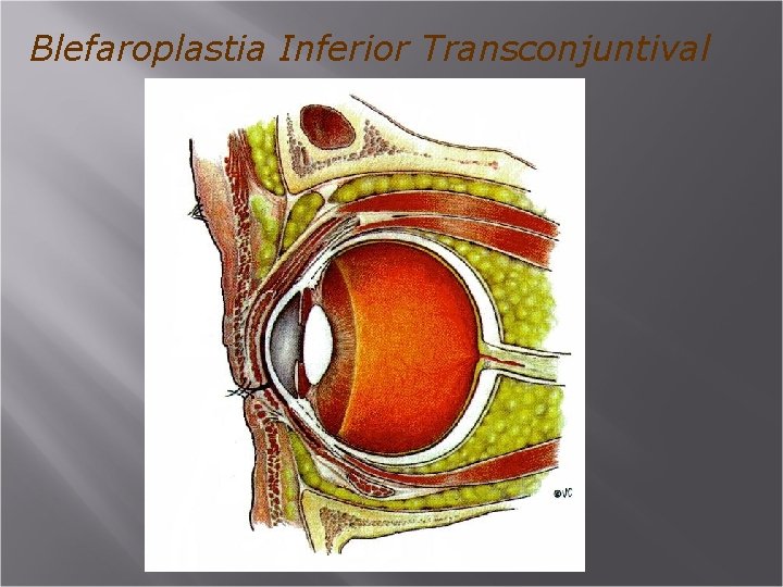 Blefaroplastia Inferior Transconjuntival 