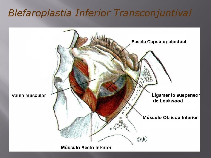 Blefaroplastia Inferior Transconjuntival 