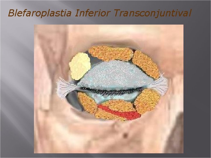 Blefaroplastia Inferior Transconjuntival 