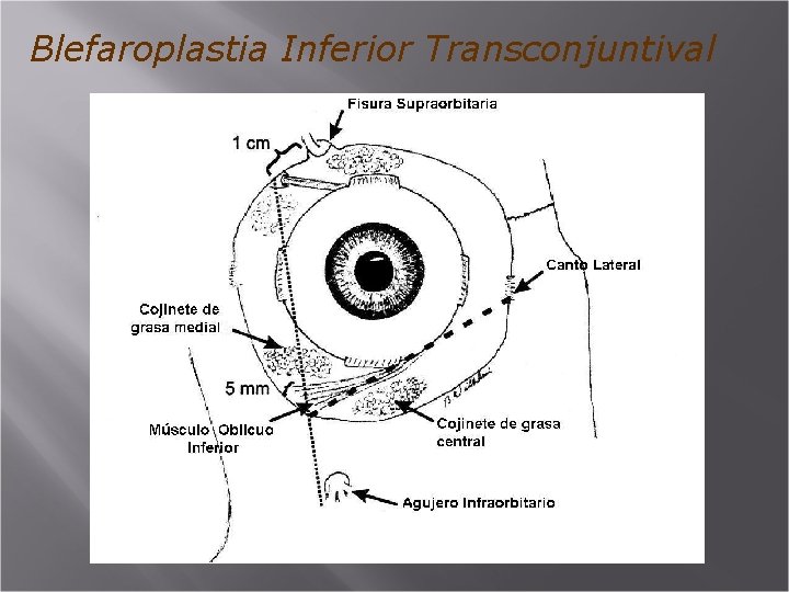 Blefaroplastia Inferior Transconjuntival 