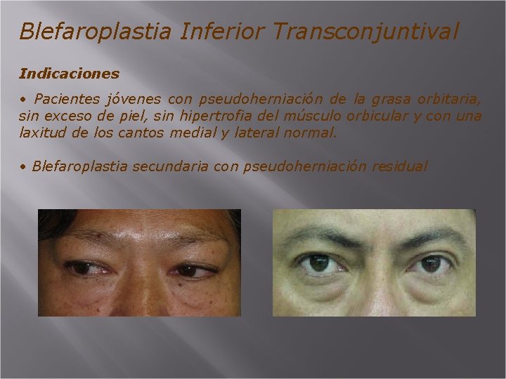 Blefaroplastia Inferior Transconjuntival Indicaciones • Pacientes jóvenes con pseudoherniación de la grasa orbitaria, sin