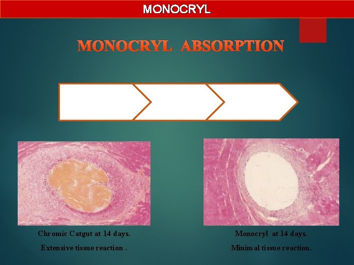 MONOCRYL ABSORPTION Synthetic Absorbable (Hydrolysis) Predictable absorption Minimal tissue reaction Chromic Catgut at 14
