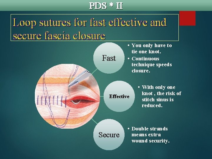 PDS * II Loop sutures for fast effective and secure fascia closure Fast •