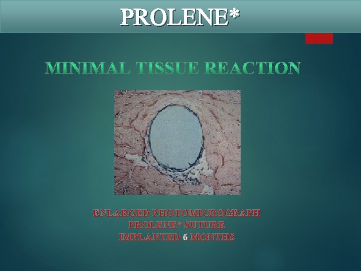 PROLENE* ENLARGED PHOTOMICROGRAPH PROLENE* SUTURE IMPLANTED 6 MONTHS 