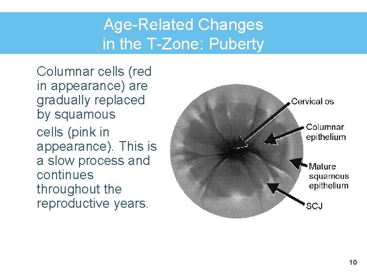 Age-Related Changes in the T-Zone: Puberty Columnar cells (red in appearance) are gradually replaced