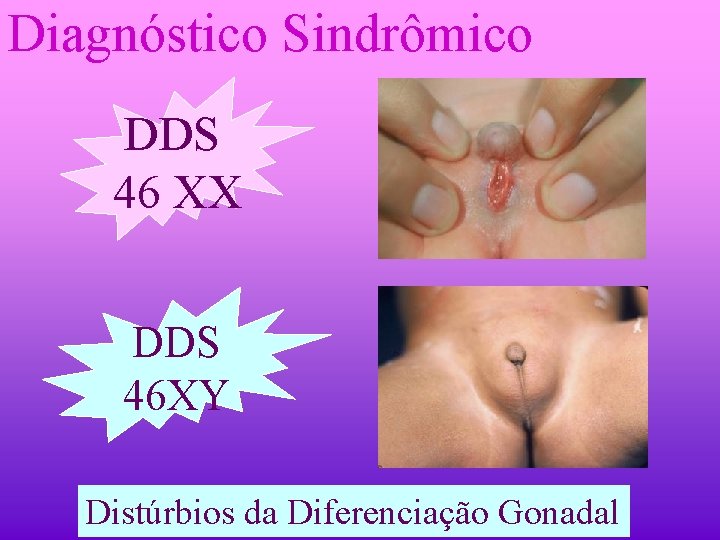 Diagnóstico Sindrômico DDS 46 XX DDS 46 XY Distúrbios da Diferenciação Gonadal 