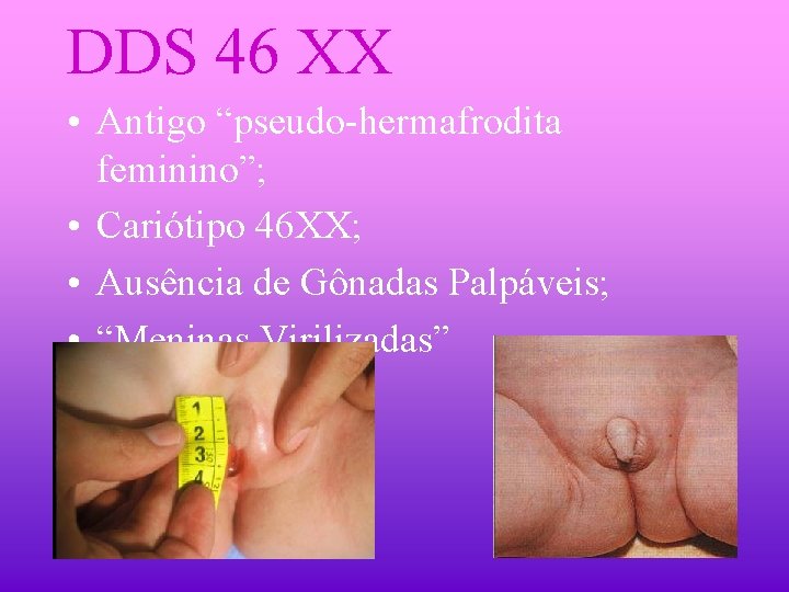 DDS 46 XX • Antigo “pseudo-hermafrodita feminino”; • Cariótipo 46 XX; • Ausência de
