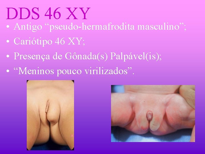 DDS 46 XY • • Antigo “pseudo-hermafrodita masculino”; Cariótipo 46 XY; Presença de Gônada(s)