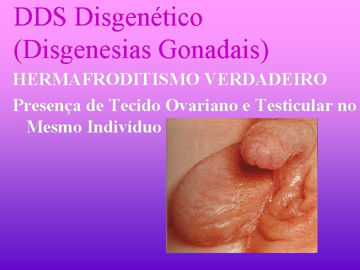 DDS Disgenético (Disgenesias Gonadais) HERMAFRODITISMO VERDADEIRO Presença de Tecido Ovariano e Testicular no Mesmo