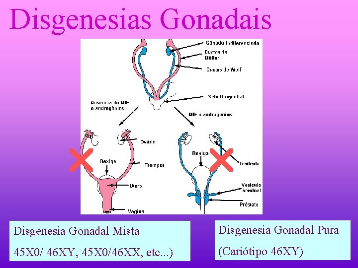 Disgenesias Gonadais Disgenesia Gonadal Mista Disgenesia Gonadal Pura 45 X 0/ 46 XY, 45