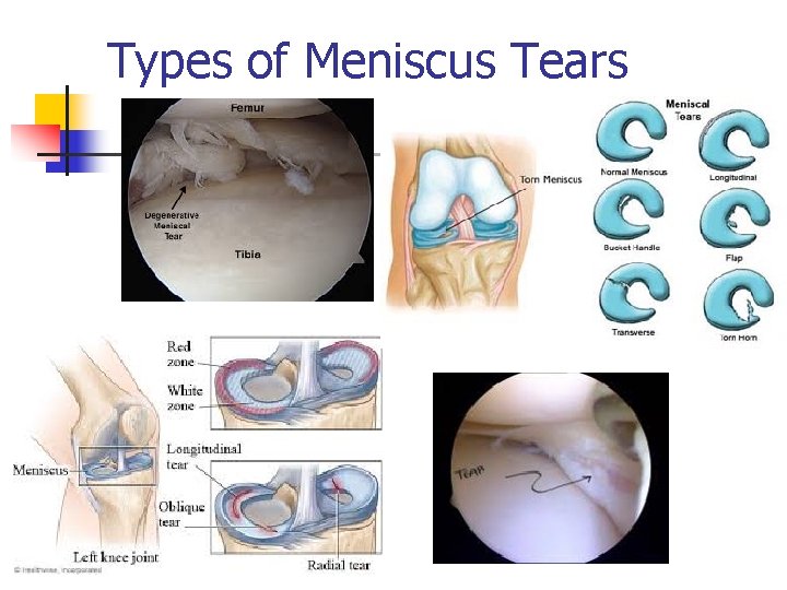 Types of Meniscus Tears 