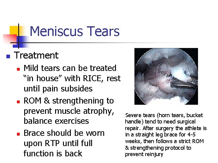 Meniscus Tears n Treatment n n n Mild tears can be treated “in house”