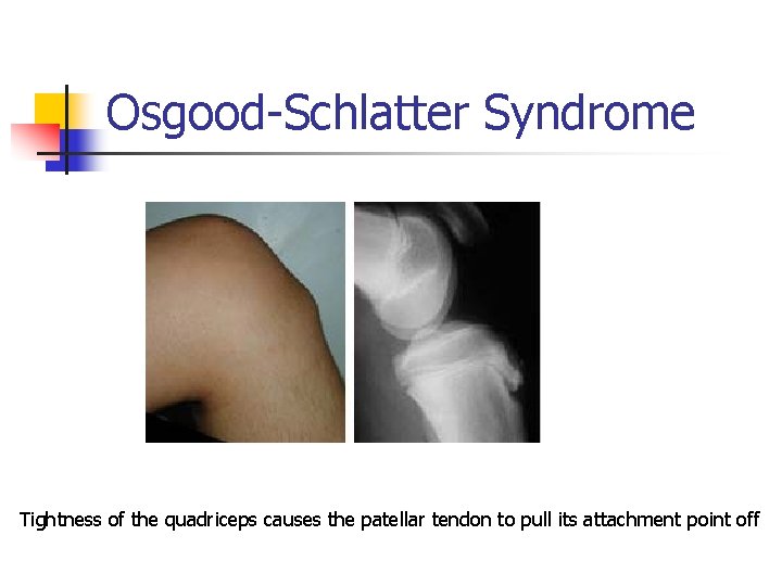 Osgood-Schlatter Syndrome Tightness of the quadriceps causes the patellar tendon to pull its attachment
