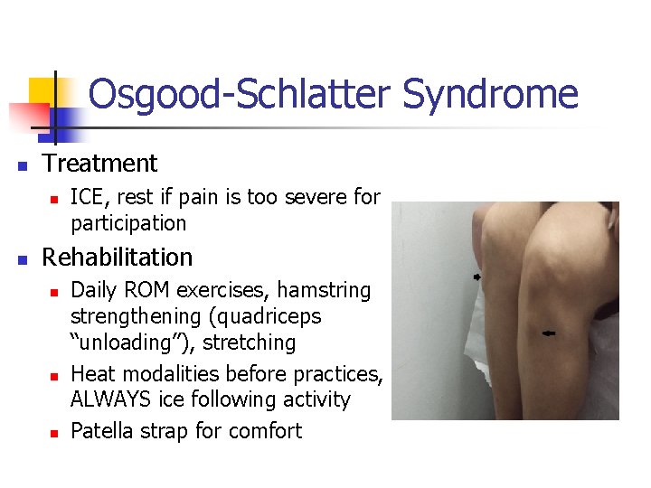 Osgood-Schlatter Syndrome n Treatment n n ICE, rest if pain is too severe for