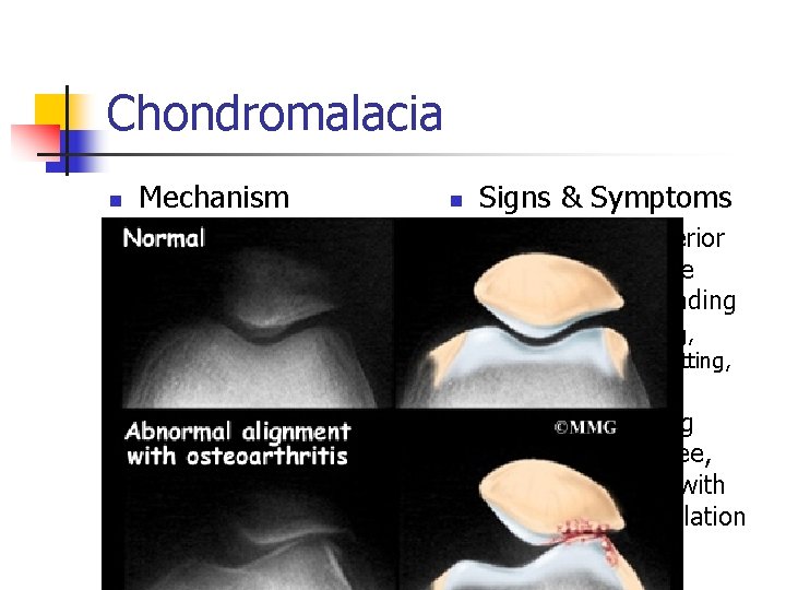 Chondromalacia n Mechanism n Overuse of the patella & quadriceps muscles n n n
