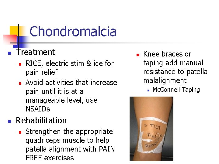 Chondromalcia n Treatment n n n RICE, electric stim & ice for pain relief