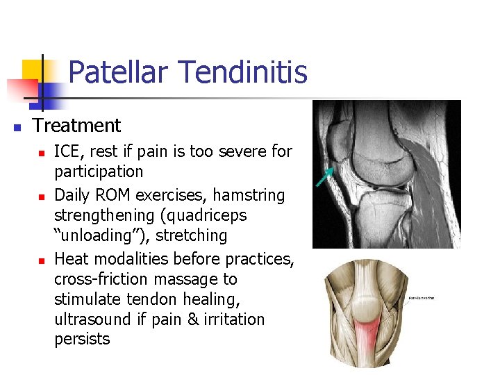 Patellar Tendinitis n Treatment n n n ICE, rest if pain is too severe