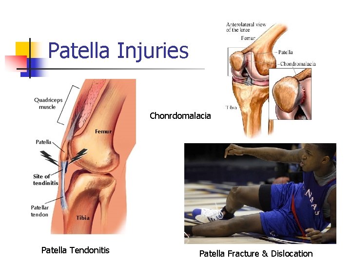 Patella Injuries Chonrdomalacia Patella Tendonitis Patella Fracture & Dislocation 