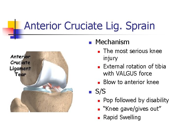 Anterior Cruciate Lig. Sprain n Mechanism n n The most serious knee injury External