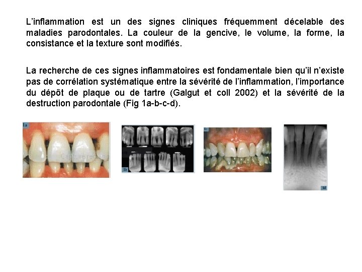 L’inflammation est un des signes cliniques fréquemment décelable des maladies parodontales. La couleur de