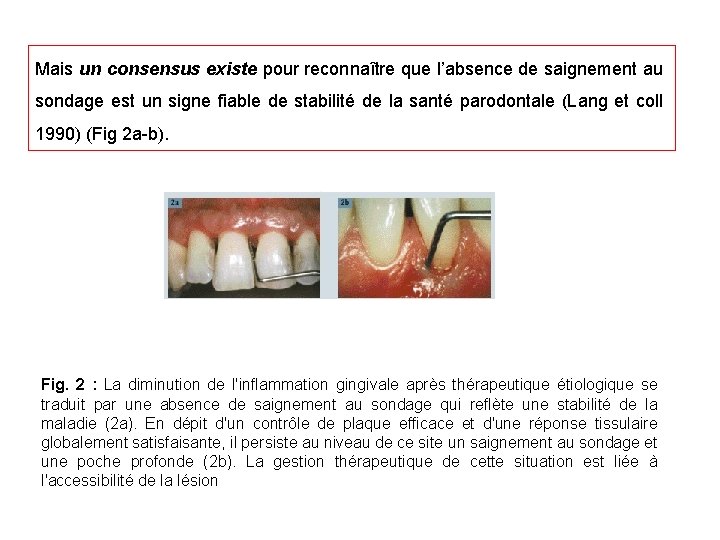 Mais un consensus existe pour reconnaître que l’absence de saignement au sondage est un