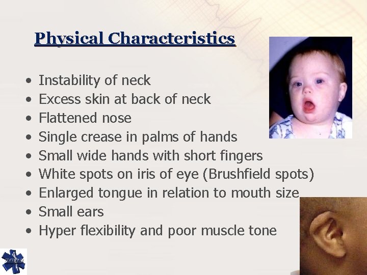 Physical Characteristics • • • Instability of neck Excess skin at back of neck