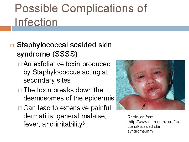 Possible Complications of Infection Staphylococcal scalded skin syndrome (SSSS) � An exfoliative toxin produced
