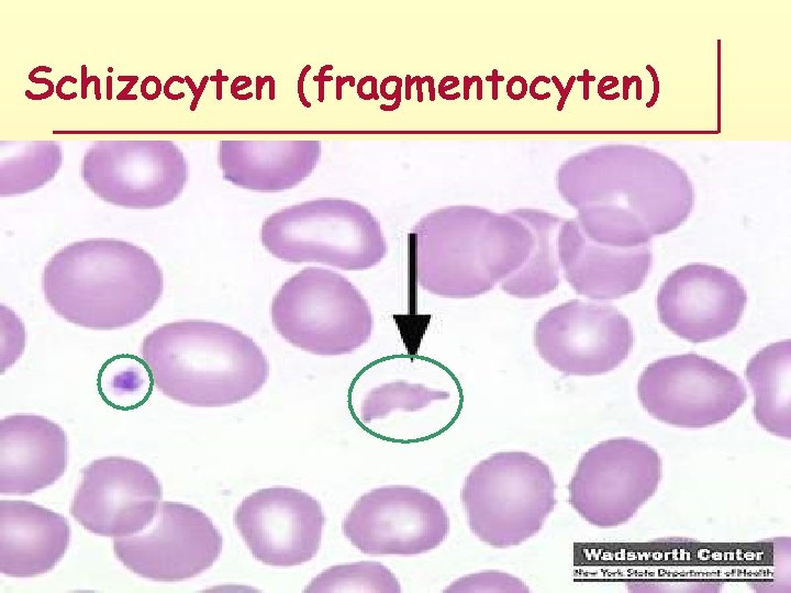 Schizocyten (fragmentocyten) 