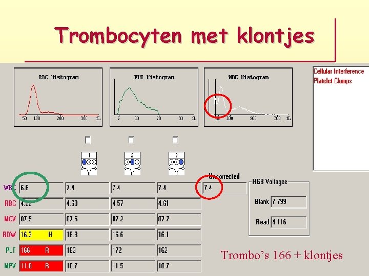Trombocyten met klontjes Trombo’s 166 + klontjes 
