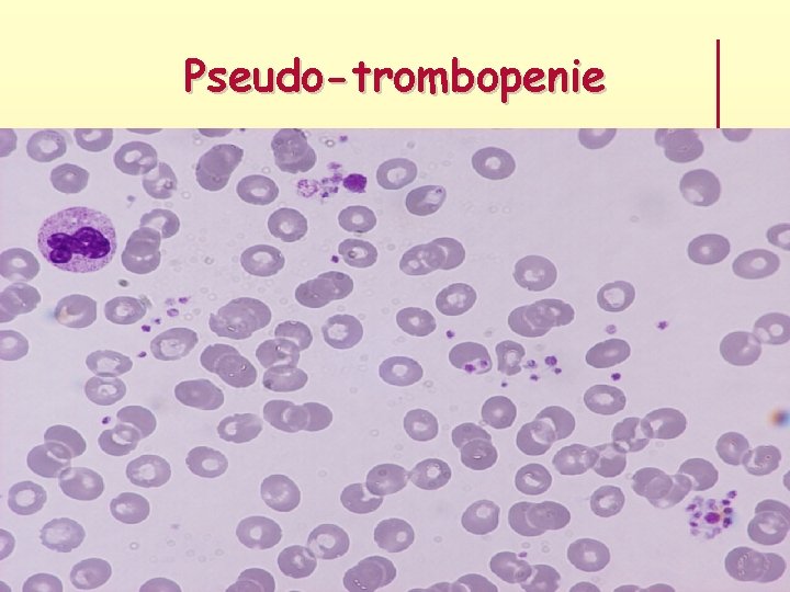 Pseudo-trombopenie 