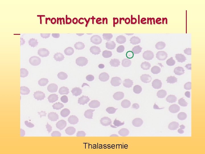 Trombocyten problemen Thalassemie 