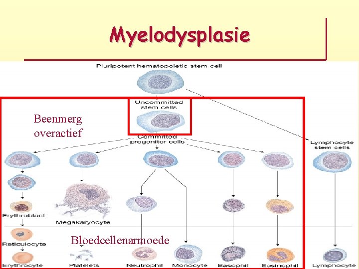 Myelodysplasie Beenmerg overactief Bloedcellenarmoede 