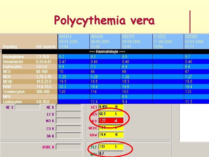 Polycythemia vera 