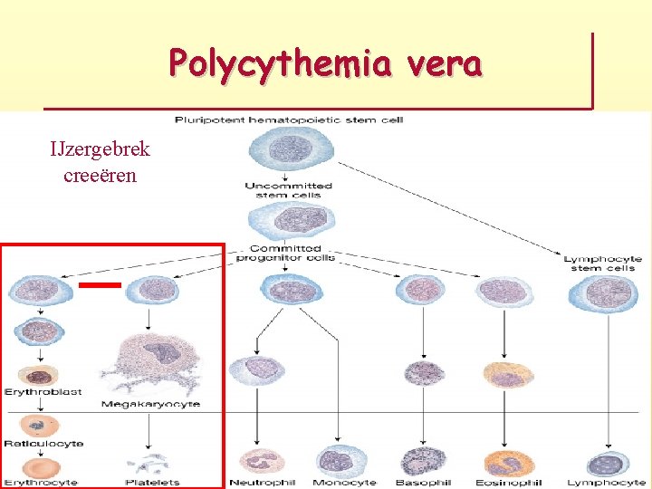 Polycythemia vera IJzergebrek creeëren 