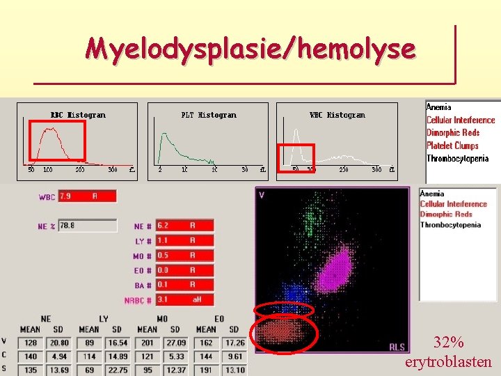 Myelodysplasie/hemolyse 32% erytroblasten 