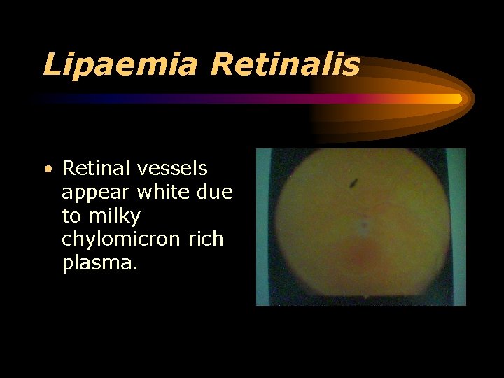 Lipaemia Retinalis • Retinal vessels appear white due to milky chylomicron rich plasma. 
