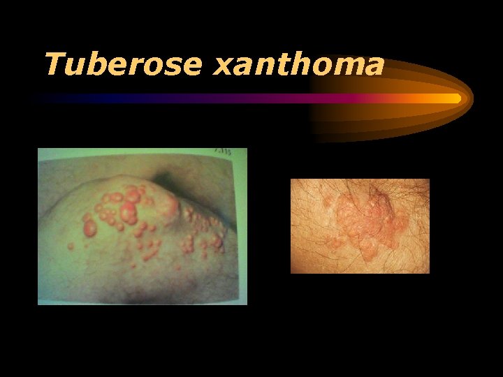 Tuberose xanthoma 