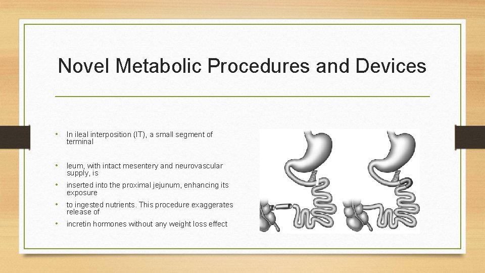 Novel Metabolic Procedures and Devices • In ileal interposition (IT), a small segment of