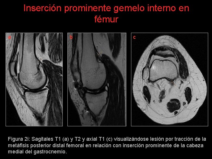 Inserción prominente gemelo interno en fémur a b c Figura 2 i: Sagitales T