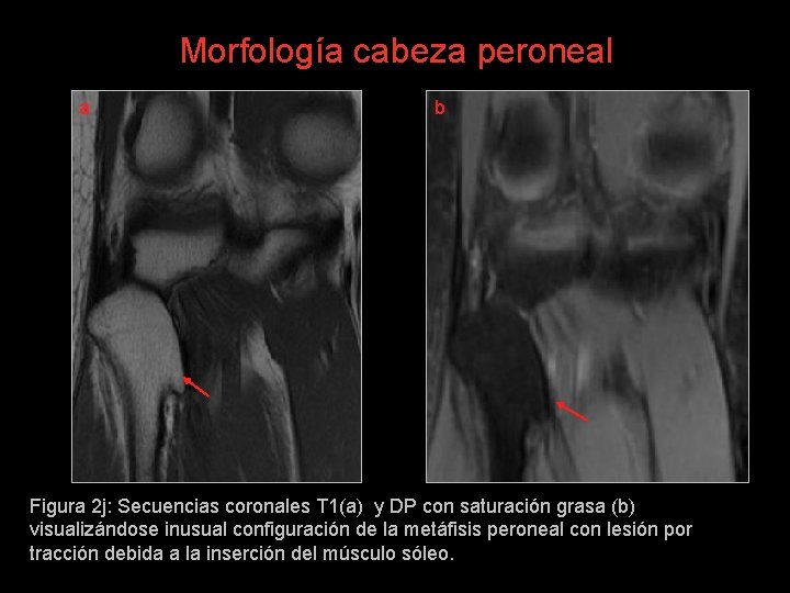 Morfología cabeza peroneal a b Figura 2 j: Secuencias coronales T 1(a) y DP