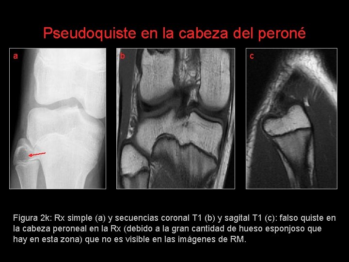 Pseudoquiste en la cabeza del peroné a b c Figura 2 k: Rx simple