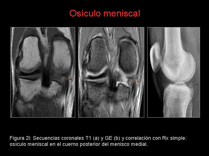 Osículo meniscal Figura 2 l: Secuencias coronales T 1 (a) y GE (b) y
