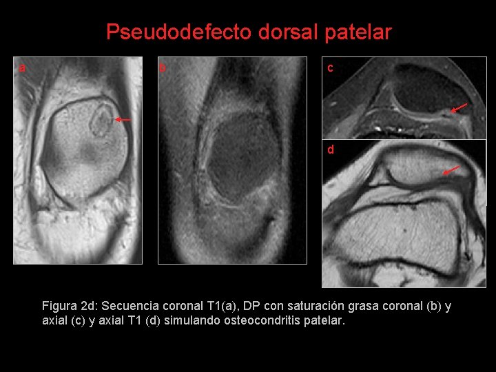 Pseudodefecto dorsal patelar a b c d Figura 2 d: Secuencia coronal T 1(a),