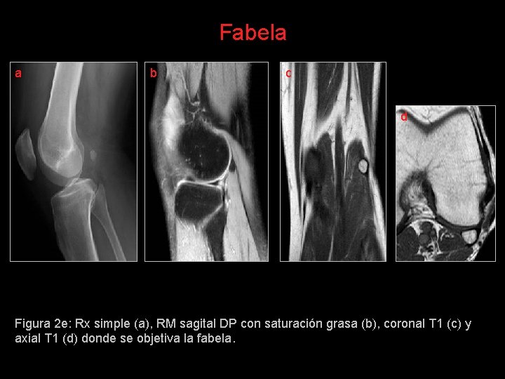Fabela a b c d Figura 2 e: Rx simple (a), RM sagital DP