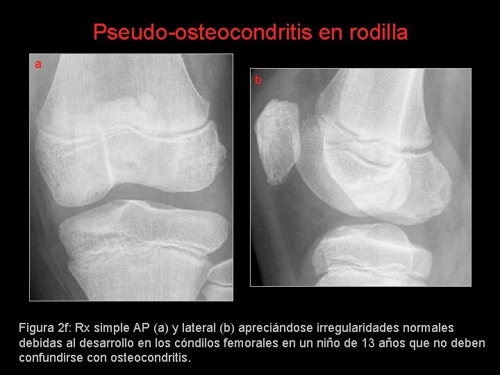 Pseudo-osteocondritis en rodilla a b Figura 2 f: Rx simple AP (a) y lateral