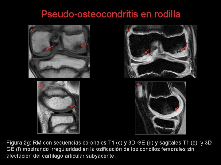 Pseudo-osteocondritis en rodilla c d e f Figura 2 g: RM con secuencias coronales