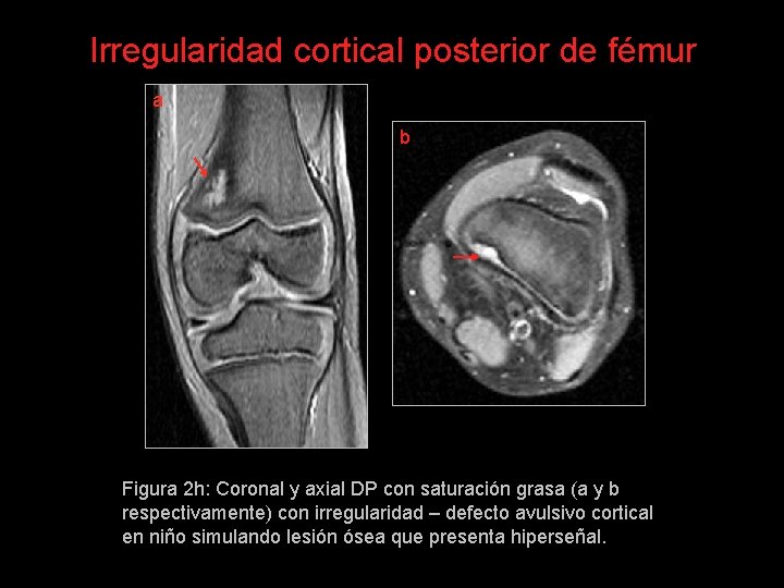 Irregularidad cortical posterior de fémur a b Figura 2 h: Coronal y axial DP